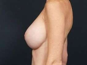 Breast Implant Revision Replacement Before & After Patient #466