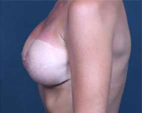 Breast Implant Revision Replacement Before & After Patient #482