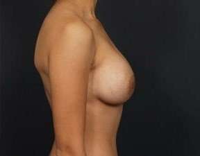 Breast Implant Revision Replacement Before & After Patient #489