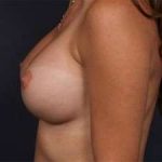 Breast Implant Revision Replacement Before & After Patient #496