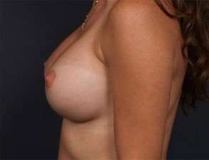 Breast Implant Revision Replacement Before & After Patient #496