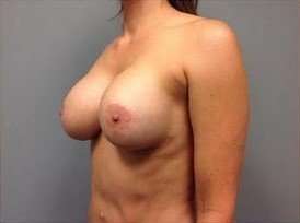Breast Implant Revision Replacement Before & After Patient #508