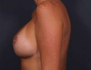 Breast Implant Revision Replacement Before & After Patient #597