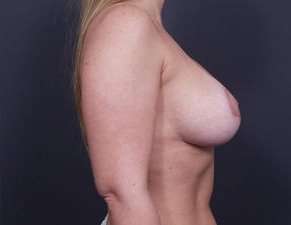 Breast Donut Mastopexy Before & After Patient #615