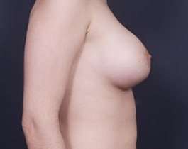 Breast Donut Mastopexy Before & After Patient #627