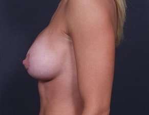 Breast Donut Mastopexy Before & After Patient #634