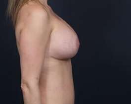 Breast Mastopexy Before & After Patient #169