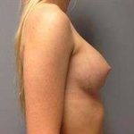 Breast Augmentation Before & After Patient #706