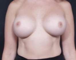 Breast Augmentation Before & After Patient #797