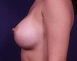 Breast Augmentation Before & After Patient #818