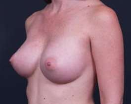 Breast Augmentation Before & After Patient #861