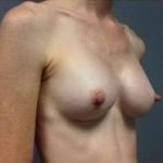 Breast Augmentation Before & After Patient #885
