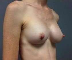 Breast Augmentation Before & After Patient #885