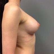 Breast Augmentation Before & After Patient #932