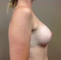 Breast Augmentation Before & After Patient #1022