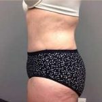 Tummy Tuck Before & After Patient #1263