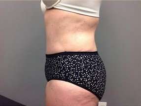 Tummy Tuck Before & After Patient #1263