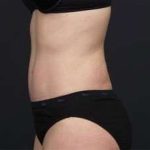 Tummy Tuck Before & After Patient #1270