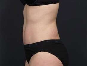 Tummy Tuck Before & After Patient #1270
