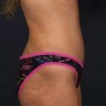 Tummy Tuck Before & After Patient #1284