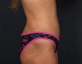 Tummy Tuck Before & After Patient #1284