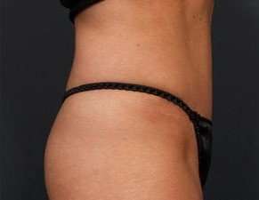 Tummy Tuck Before & After Patient #1296