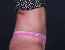 Tummy Tuck Before & After Patient #1303
