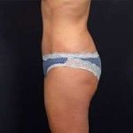 Tummy Tuck Before & After Patient #1310