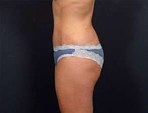 Tummy Tuck Before & After Patient #1310