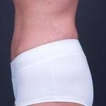 Tummy Tuck Before & After Patient #1322