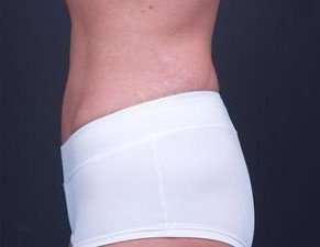 Tummy Tuck Before & After Patient #1322