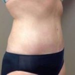 Tummy Tuck Before & After Patient #1349