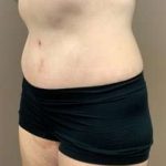 Tummy Tuck Before & After Patient #1371