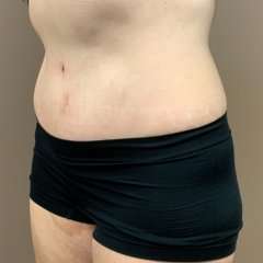Tummy Tuck Before & After Patient #1371