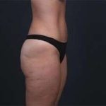 Tummy Tuck Before & After Patient #1378