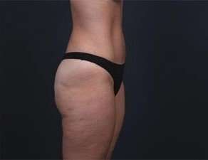 Tummy Tuck Before & After Patient #1378