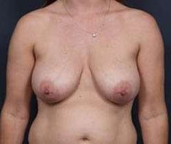 Breast Mastopexy Before & After Patient #115