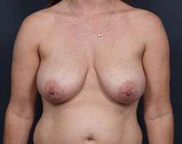 Breast Mastopexy Before & After Patient #115