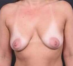 Breast Donut Mastopexy Before & After Patient #615