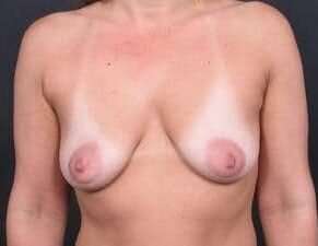 Breast Donut Mastopexy Before & After Patient #615
