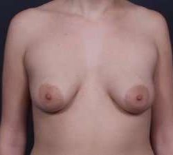 Breast Donut Mastopexy Before & After Patient #627