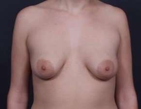 Breast Donut Mastopexy Before & After Patient #627