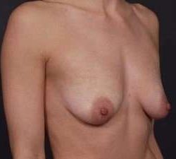 Breast Donut Mastopexy Before & After Patient #634