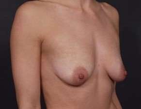 Breast Donut Mastopexy Before & After Patient #634