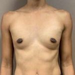 Breast Augmentation Before & After Patient #661