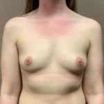 Breast Augmentation Before & After Patient #681