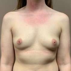 Breast Augmentation Before & After Patient #681