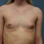 Breast Augmentation Before & After Patient #706