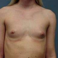 Breast Augmentation Before & After Patient #706