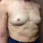 Breast Augmentation Before & After Patient #716
